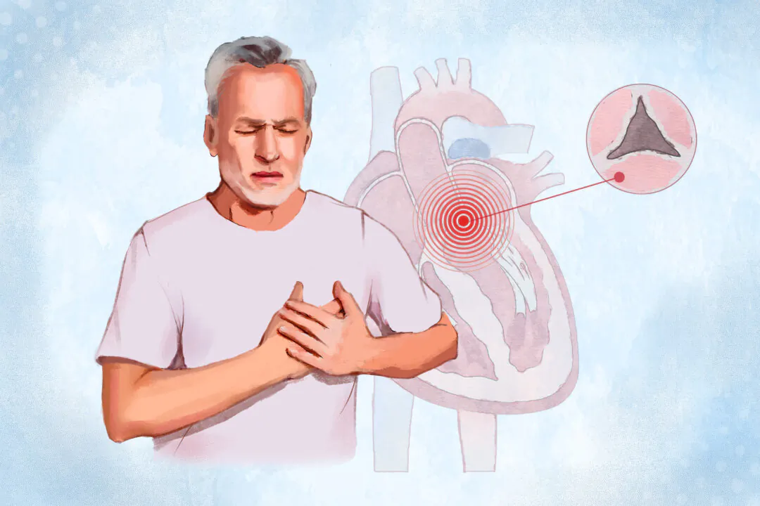 Aortic stenosis is a heart valve disorder that restricts blood flow from the heart. (Illustration by Fei Meng)