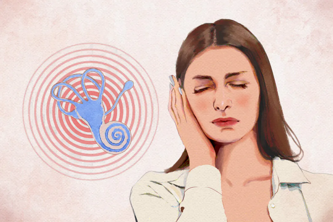 Ménière’s disease is an ear disorder caused by buildup of fluid in the inner ear, leading to vertigo, tinnitus, and hearing loss. (Illustration by Fei Meng)