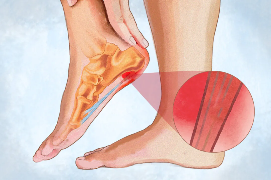 Plantar fasciitis is a common condition that causes pain on the bottom of the foot, usually near the heel bone. (Illustration by Fei Meng)