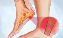 Plantar Fasciitis: Leading Cause of Heel Pain, 3 Natural Treatments