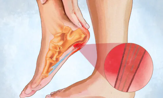 Plantar Fasciitis: Symptoms, Causes, Treatments, and Natural Approaches