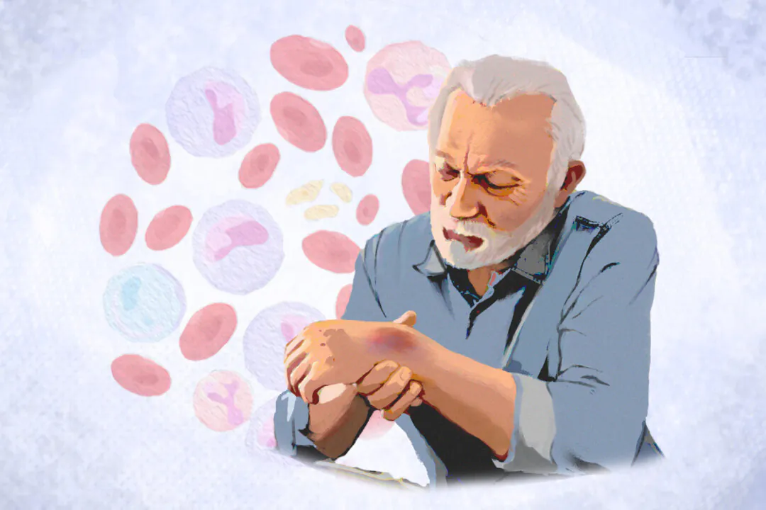 Leukemia occurs when the proliferation of abnormal blood cells outpaces that of healthy blood cells. (Illustration by Fei Meng)