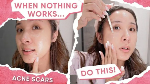 How to Really Fade Dark Spots That Aren’t Fading (Ft. Numbuzin)