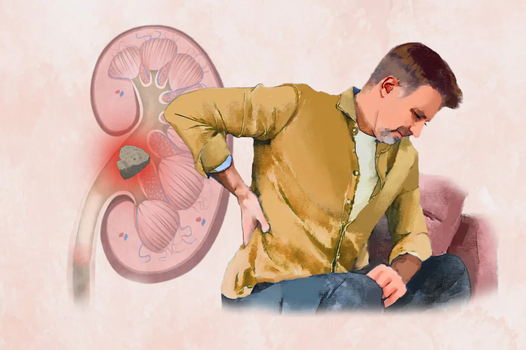 Kidney stones are relatively common, with prevalence higher in men and white people. (Illustration by Fei Meng)