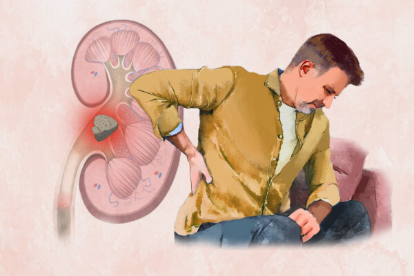 Kidney Stones: Symptoms, Causes, Treatments, and Natural Approaches