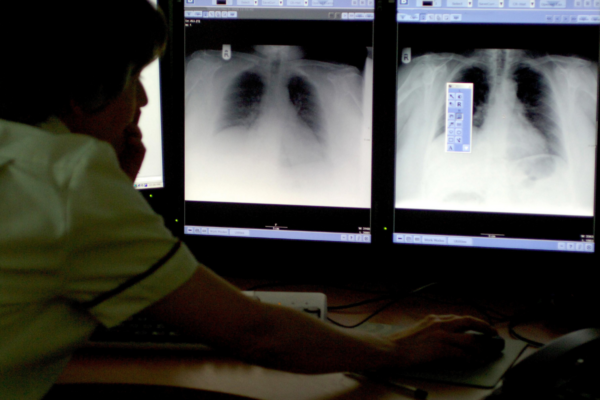 Allow People With Lung Cancer Symptoms to Self-Refer for Chest X-Rays, Experts Say