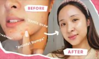 3 Tips That Cleared My Acne!