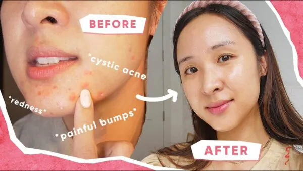 3 Tips That Cleared My Acne!