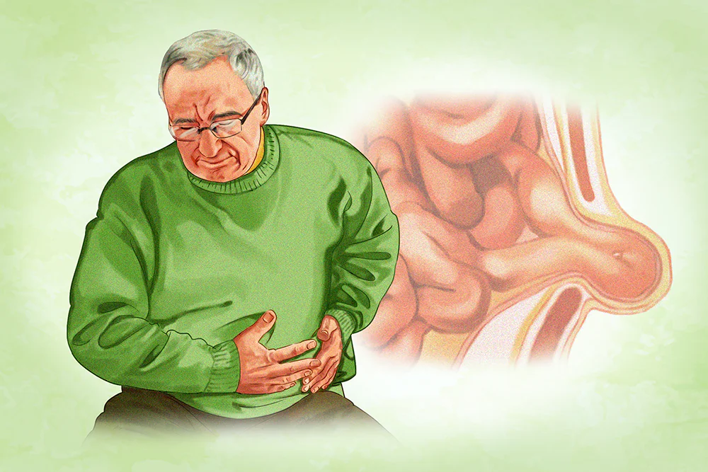 Most hernias occur when pressure forces part of the insides to protrude through a weak spot or tear in muscle or tissue. (Illustration by Minghui Zhang, Shutterstock)
