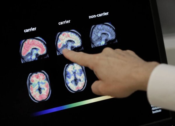 Americans' Dementia Cases Forecast to Double by 2060, Study Finds