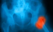 US Preventive Task Force Upholds Osteoporosis Screening Recommendations