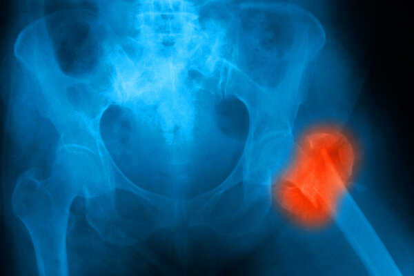 US Preventive Task Force Upholds Osteoporosis Screening Recommendations