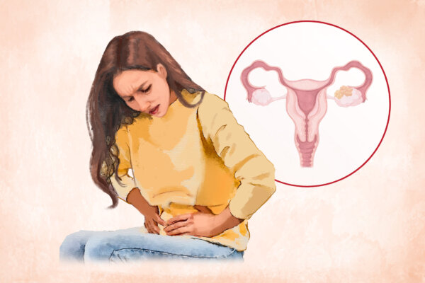 Ovarian Cancer: Symptoms, Causes, Treatments, and Natural Approaches