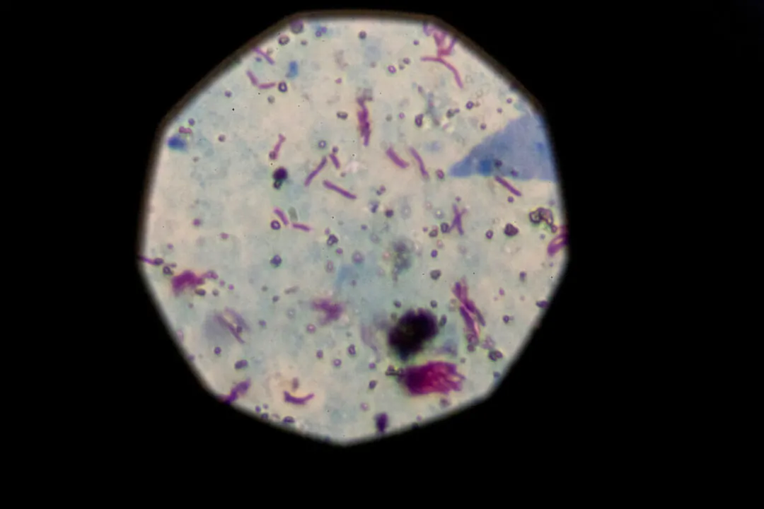 A sample that tested positive for tuberculosis is seen from a microscope in Buenos Aires, Argentina, on March 29, 2019. (Magali Druscovich/Reuters)
