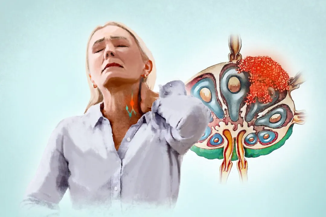 Painless, swollen lymph nodes, especially in the neck, are an early sign of lymphoma. (Illustration by The Epoch Times, Shutterstock)