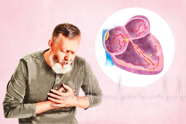 Atrial Fibrillation: Symptoms, Causes, Treatments, and Natural Approaches