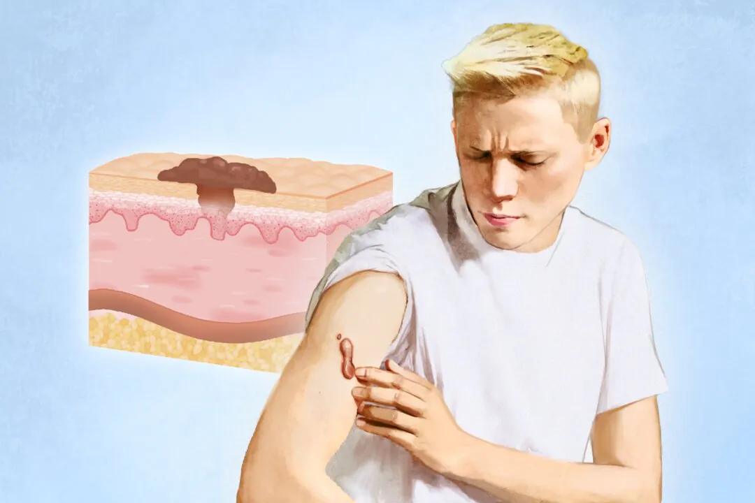 Keloids vary in color, from pink and purple to brown or hyperpigmented, changing as they grow and mature. (Illustration by The Epoch Times, Shutterstock)