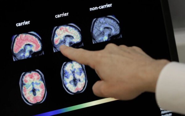 Unusual Finding for Older Adults
