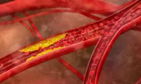 Cholesterol-Lowering Drugs May Affect Your Health