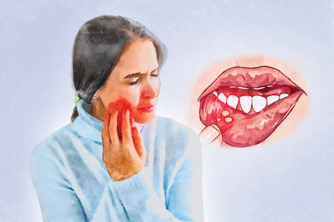 Canker sores are small, painful ulcers inside the mouth that can make eating, drinking, or speaking uncomfortable. (The Epoch Times/Shutterstock)