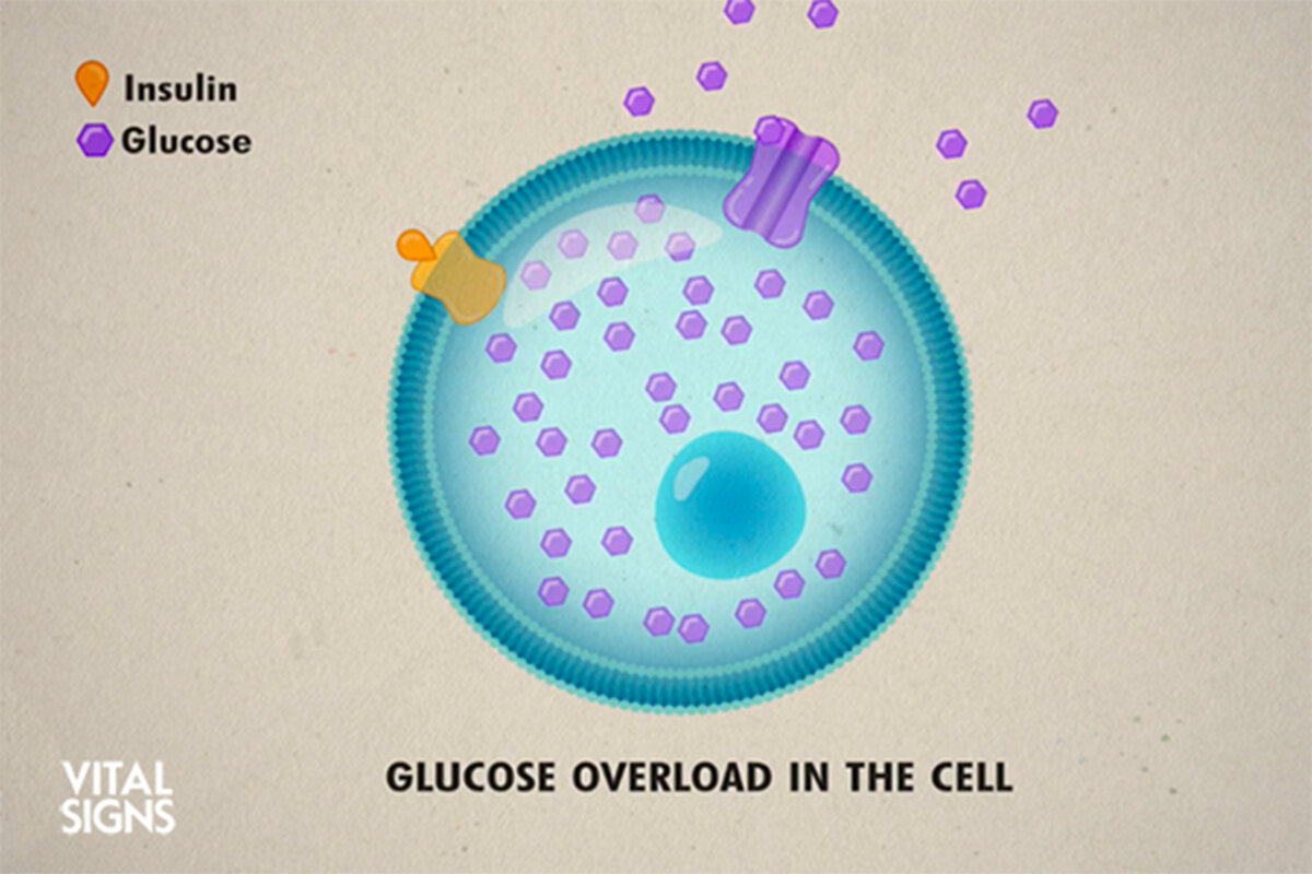 Type 2 diabetes is caused by cells being overloaded with glucose, not cell dysfunction, says Dr. Jason Fung M.D. in “Reverse Type 2 Diabetes” on “Vital Signs.”