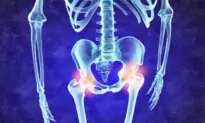 Osteoarthritis: Gene Study Finds New Drug Targets and Treatment Options