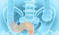 Screening Initiative Cuts Down Colorectal Cancer Rates, Deaths by 50 Percent