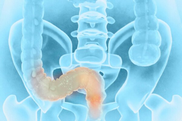 Tests That May Alter Colorectal Cancer Outcomes