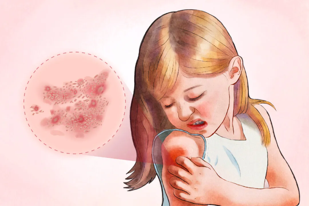 Eczema is a chronic skin condition that causes dryness, inflammation, and intense itching. (The Epoch Times/Shutterstock)
