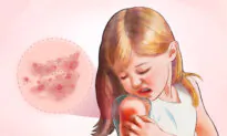 Eczema: Symptoms, Causes, Treatments, and Natural Approaches