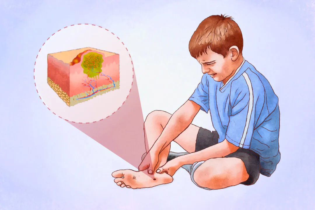 Plantar warts appear as thickened skin with tiny black dots and may be painful, especially when walking. (The Epoch Times/Shutterstock)