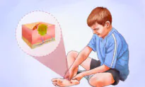 Plantar Warts: A Viral Foot Infection With 11 Treatment Options