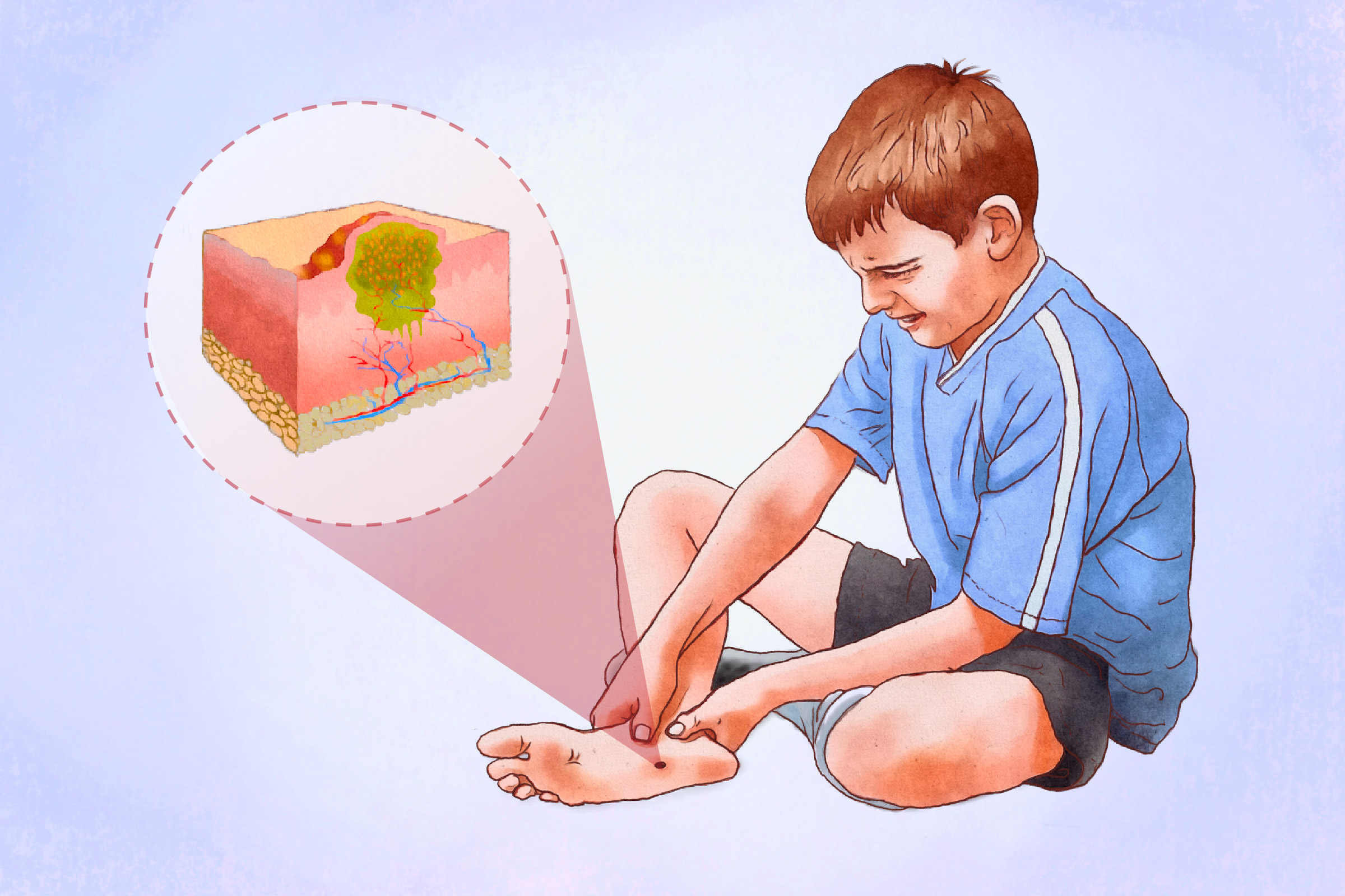 Plantar Warts: Symptoms, Causes, Treatments, and Natural Approaches