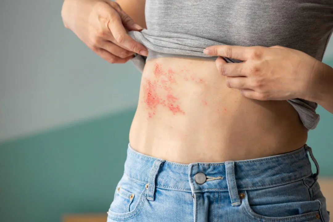Patients with shingles typically develop clusters of small blisters that can cause intense pain even with the slightest touch. (aslysun/Shutterstock)