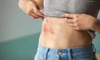 Healing Shingles Naturally: Herbal Recipes to Boost Immunity and Protect Your Nerves