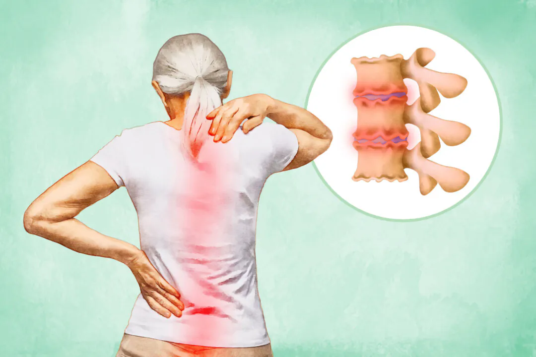 Bone spurs in the spine can press on nearby nerves, leading to pain, stiffness, or numbness—especially in the neck or lower back. (The Epoch Times/Shutterstock)