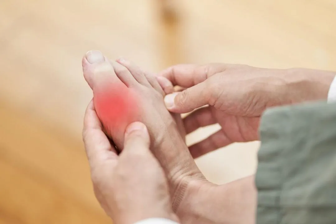 Gout often strikes the big toe’s first metatarsophalangeal joint, presenting with redness, swelling, heat, and severe pain. （mapo_japan/Shutterstock） 

