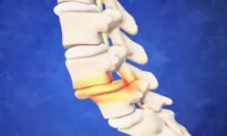 How to Manage Spondylolisthesis Without Surgery