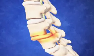 How to Manage Spondylolisthesis Without Surgery