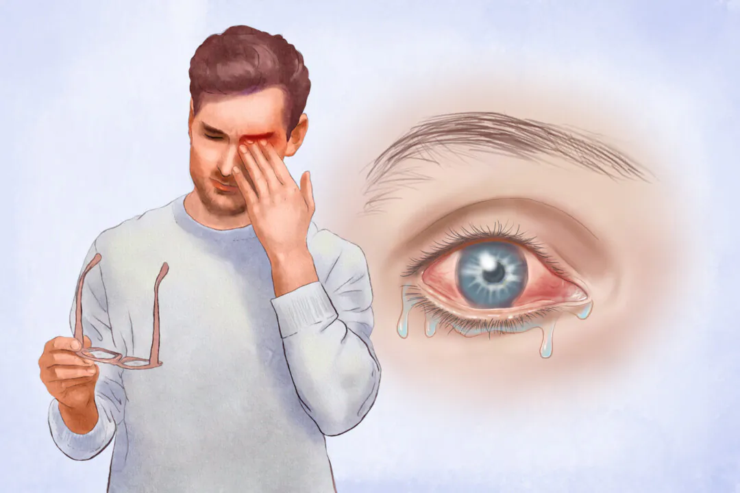 Redness, swelling, and discharge are common signs of pink eye, also known as conjunctivitis. (The Epoch Times/Shutterstock)