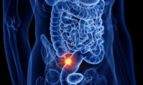 Appendix Cancer Rates Quadruple Among Older Millennials, Signs Often Missed