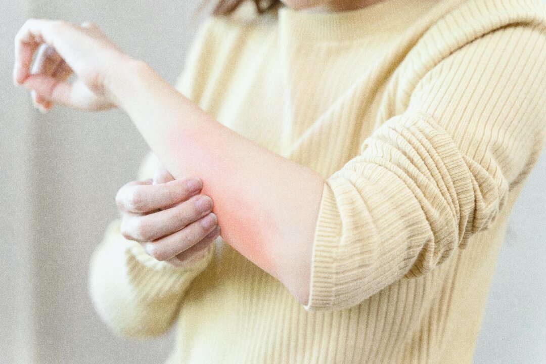 Regulating the body’s constitution through TCM can help relieve persistent or difficult-to-treat skin itchiness. (Pormezz/Shutterstock)