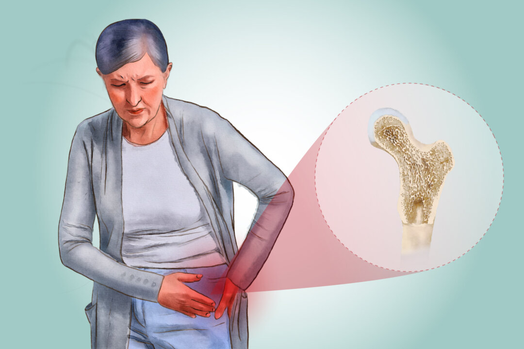 Hip fractures from osteoporosis can cause lasting pain, mobility loss, and serious health risks—especially in older women. (The Epoch Times/Shutterstock)