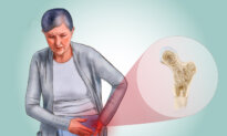 Osteoporosis: The Silent Disease That Steals Your Bones—How to Prevent Bone Loss