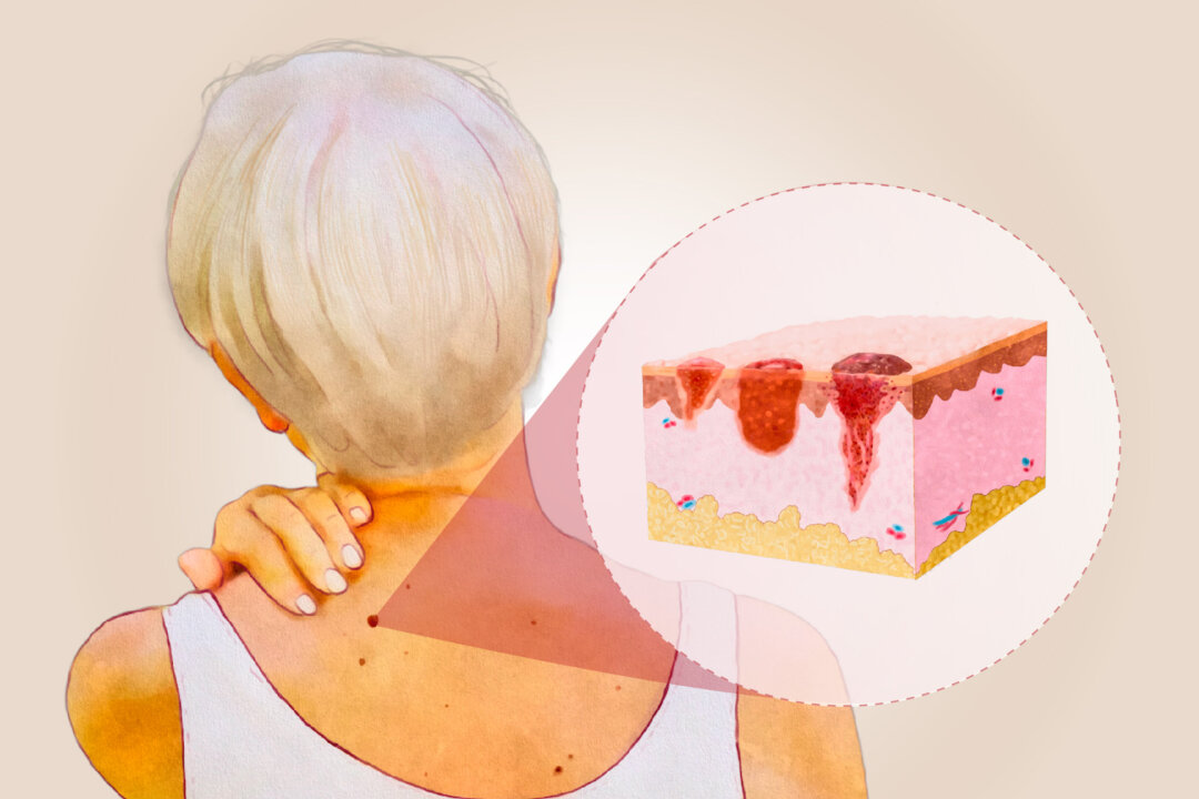 Protecting your skin and knowing the warning signs may help reduce your risk of skin cancer. Illustration by The Epoch Times, Shutterstock