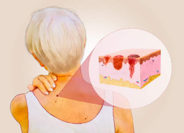Skin Cancer—Warning Signs & 8 Treatments