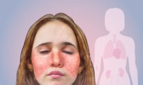 Lupus: An Unpredictable Disease That Can Affect Any Part of the Body—Here Are the Signs