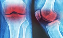 3 Non-Drug Therapies for Knee Osteoarthritis