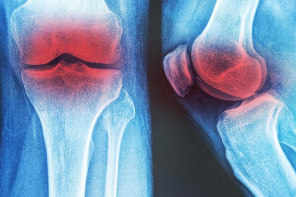 3 Non-Drug Therapies for Knee Osteoarthritis