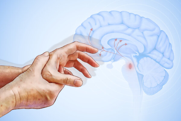 Parkinson’s Disease: The Silent Thief of Dopamine—Natural Ways to Relieve Symptoms